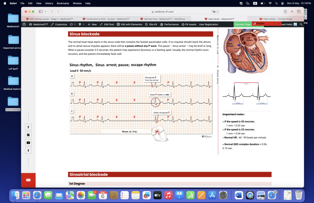 ECG of heart block